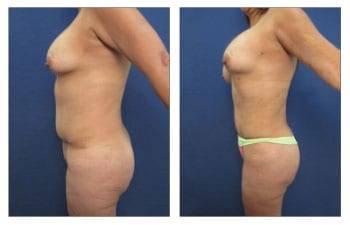 Renuvion Before and After