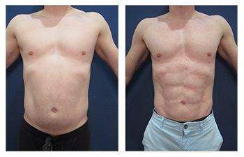 Gynecomastia + HD Liposuction — #SS098 Gynecomastia + HD Liposuction — #SS098