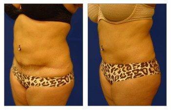 Amazing Results of Mini Tummy Scars Amazing Results of Mini Tummy Scars