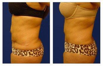 Mini tummy tuck for scar revision Mini tummy tuck for scar revision