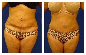 One of the most amazing results of a mini tummy tuck is correcting prior contouring scars. front view One of the most amazing results of a mini tummy tuck is correcting prior contouring scars. front view