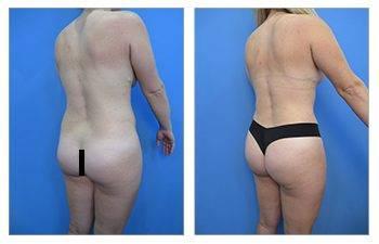 Before and after tummy tuck with safe BBL procedure. Before and after tummy tuck with safe BBL procedure.
