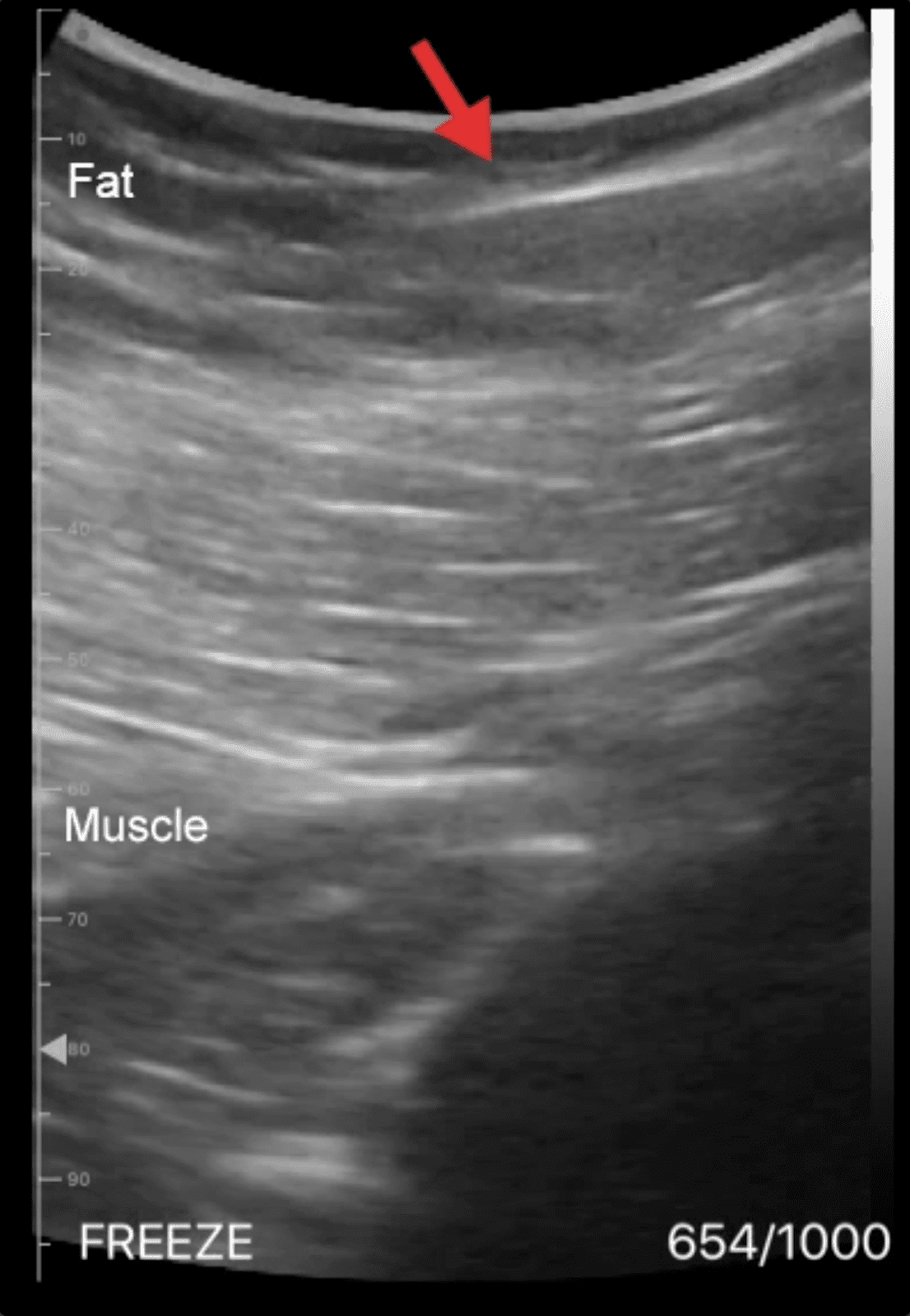 A close-up of an ultrasound following the Safe BBL Protocol. A close-up of an ultrasound following the Safe BBL Protocol.