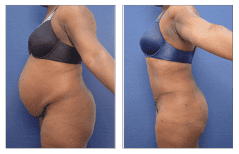 Skin reduction surgery before and after tummy tuck. Skin reduction surgery before and after tummy tuck.