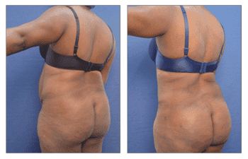 Skin reduction Surgery Skin reduction Surgery
