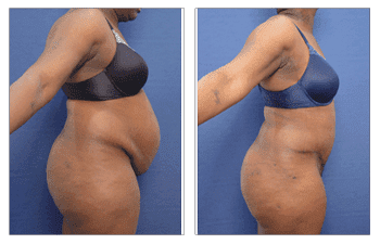 Skin reduction Surgery 2 Skin reduction Surgery 2