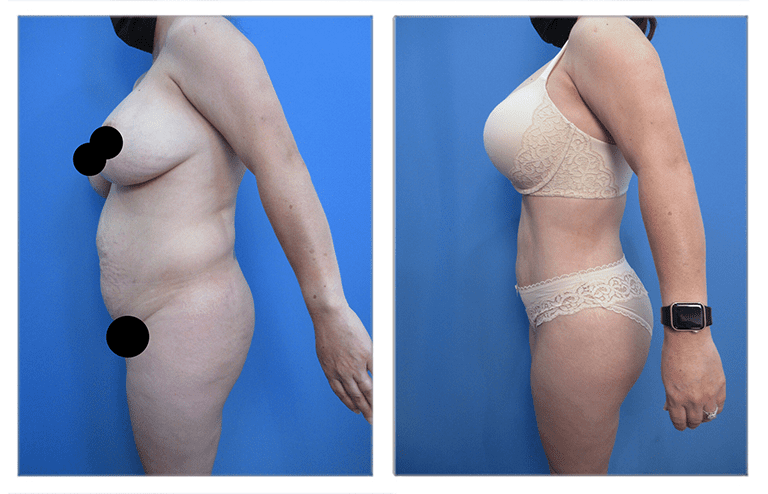 High Definition Body Contouring High Definition Body Contouring