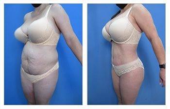 High Definition Body Contouring High Definition Body Contouring