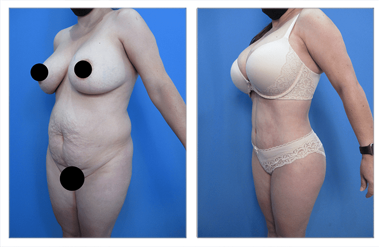 High Definition Body Contouring High Definition Body Contouring
