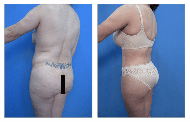 High Definition Body Contouring High Definition Body Contouring