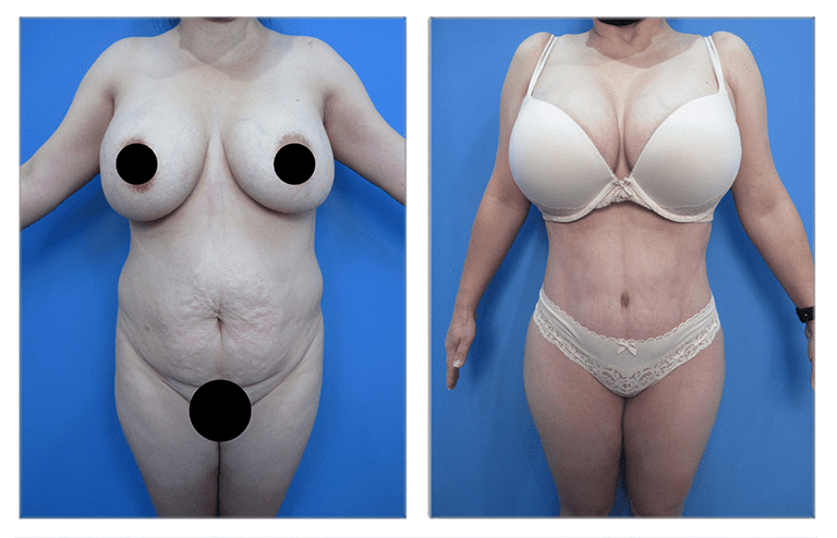 High Definition Body Contouring High Definition Body Contouring