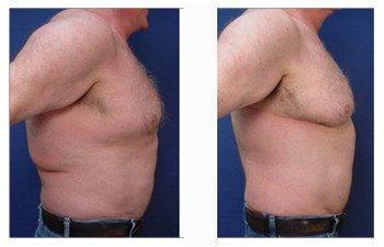 post bariatric surgery patient 2 right view post bariatric surgery patient 2 right view
