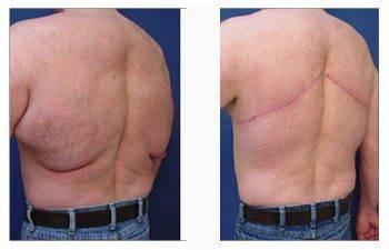 post bariatric surgery patient 2 back left view
