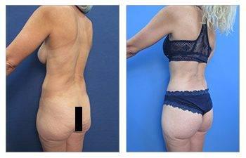 Skinny BBL Surgeons Skinny BBL Surgeons