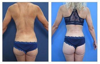 Skinny BBL Surgeons Skinny BBL Surgeons