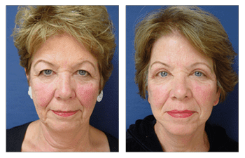 Neck Lift Newport Beach Neck Lift Newport Beach