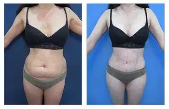 Check out these amazing tummy tuck transformations in our plastic surgery before and after photos on social media. Check out these amazing tummy tuck transformations in our plastic surgery before and after photos on social media.