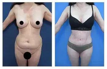 Check out the amazing tummy tuck transformation with these before and after photos shared on social media. Check out the amazing tummy tuck transformation with these before and after photos shared on social media.