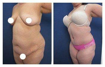 A woman's breast before and after surgery for breast augmentation.