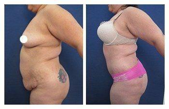 Staged body contouring with tummy tuck before and after transformations.