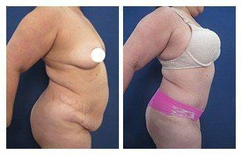 Tummy tuck before and after with staged body contouring.