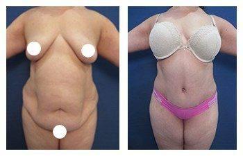 Staged body contouring - see tummy tuck before and after transformations.