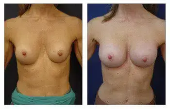 Before and after breast surgery, featuring The Best Breast Band for Breast Augmentation. Before and after breast surgery, featuring The Best Breast Band for Breast Augmentation.