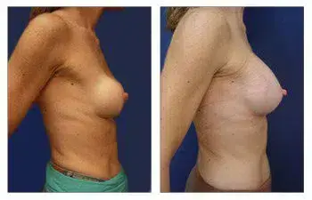 The Best Breast Band for Breast Augmentation showcasing a woman's breast before and after surgery. The Best Breast Band for Breast Augmentation showcasing a woman's breast before and after surgery.