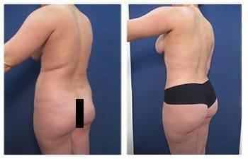 Tips For Fast Recovery After VASER Liposuction, CPSI, width: 350px; height: 225px; Tips For Fast Recovery After VASER Liposuction, CPSI, width: 350px; height: 225px;