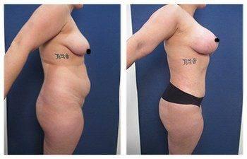 Tips For Fast Recovery After VASER Liposuction, CPSI, width: 350px; height: 225px; Tips For Fast Recovery After VASER Liposuction, CPSI, width: 350px; height: 225px;