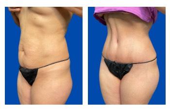 Top 9 Female Celebrity Plastic Surgery Stories results — photo 2 Top 9 Female Celebrity Plastic Surgery Stories results — photo 2 | SurgiSculpt®