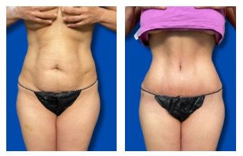 Top 9 Female Celebrity Plastic Surgery Stories results — front view — photo 1 Top 9 Female Celebrity Plastic Surgery Stories results — front view — photo 1 | SurgiSculpt®