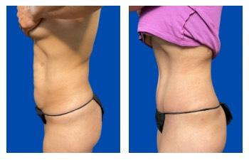 Top 9 Female Celebrity Plastic Surgery Stories results — side view — photo 3 Top 9 Female Celebrity Plastic Surgery Stories results — side view — photo 3 | SurgiSculpt®