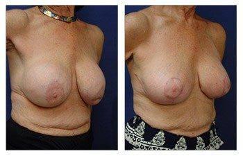 Top Breast Revision Surgeon Top Breast Revision Surgeon
