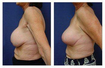 Mommy Makeover Mommy Makeover