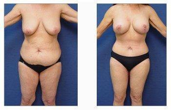 post bariatric surgery patient 3 front view