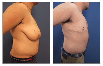 Transgender Female to Male Breast Surgery Transgender Female to Male Breast Surgery