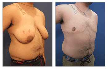 Male Breast Surgery Los Angeles Male Breast Surgery Los Angeles