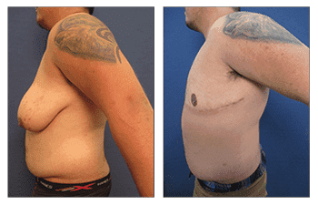 Transgender Breast Surgery San Diego Transgender Breast Surgery San Diego
