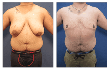Transgender Female to Male Transgender Female to Male