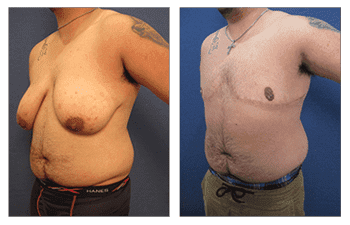 Male Breast Implants Laguna Beach Male Breast Implants Laguna Beach