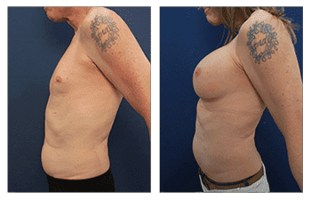 Transgender Breast Implants San Diego Transgender Breast Implants San Diego