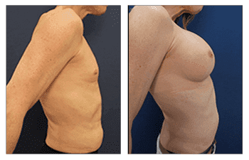 Breast Augmentation Newport Beach Breast Augmentation Newport Beach
