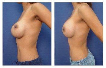 edited Copy-of-orange-county-breast-augmentation-revision-newport-beach-patient-26-left