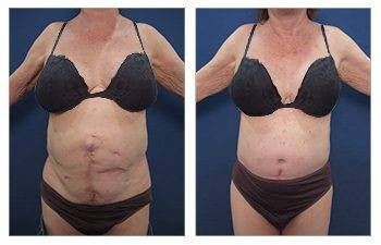 Tummy Tuck — #SS278 Tummy Tuck — #SS278