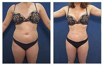 Tummy Tuck — #SS057 Tummy Tuck — #SS057