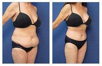 Breast Surgery + Tummy Tuck — #SS061 Breast Surgery + Tummy Tuck — #SS061