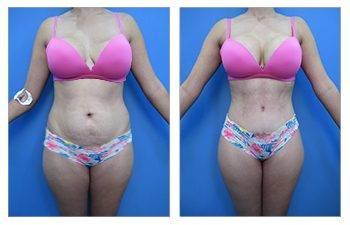 Lipo + Tummy Tuck Combination Lipo + Tummy Tuck Combination