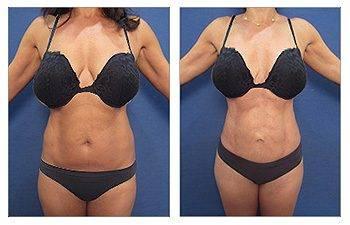 Tummy Tuck Newport Beach Tummy Tuck Newport Beach