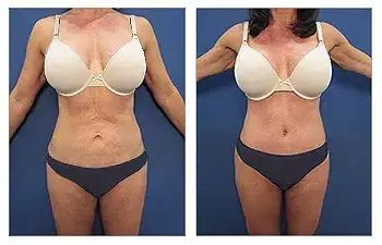 Liposuction — #SS027 Liposuction — #SS027